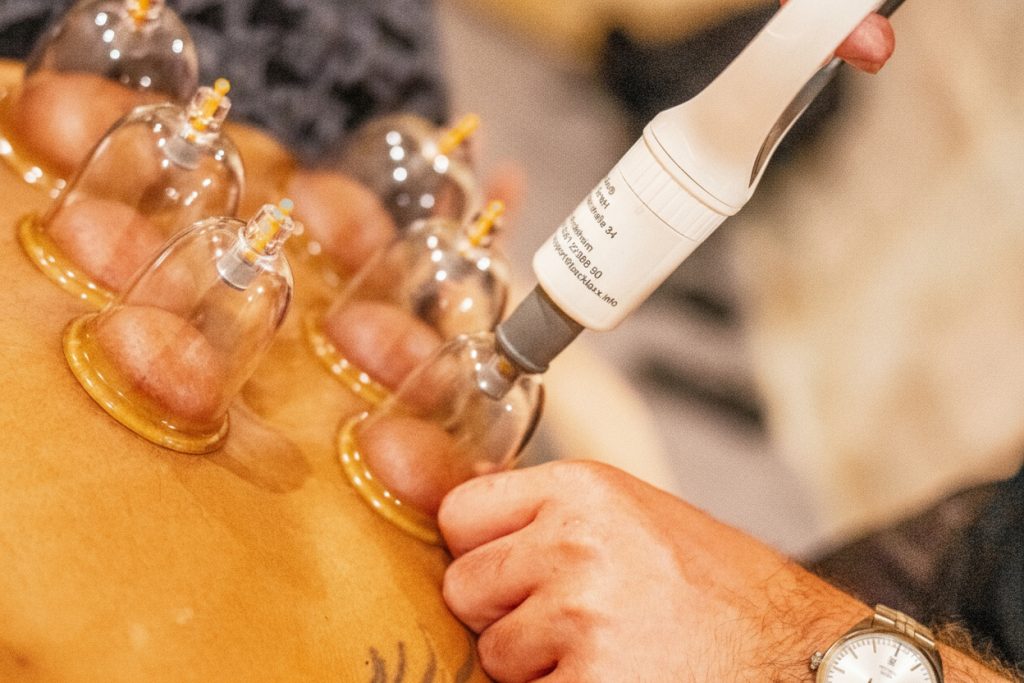 Cupping Therapy